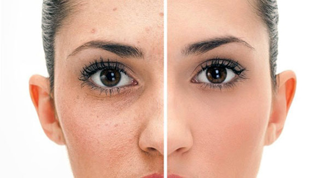 Как быстро избавиться от прыщей